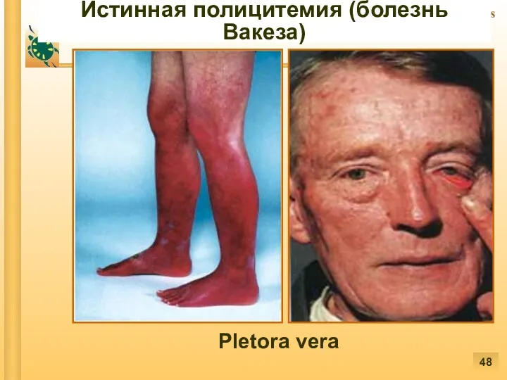 Истинная полицитемия (болезнь Вакеза) Pletora vera