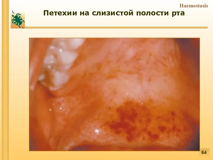 Do not blanch with pressure (cf. angiomas) Not palpable (cf. vasculitis) Петехии на слизистой полости рта