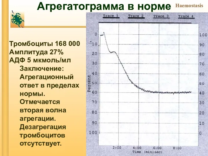 Агрегатограмма в норме Тромбоциты 168 000 Амплитуда 27% АДФ 5