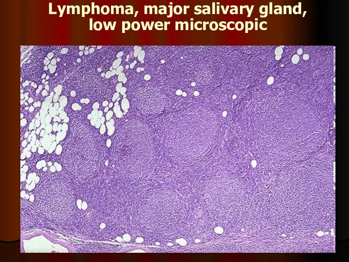 Lymphoma, major salivary gland, low power microscopic