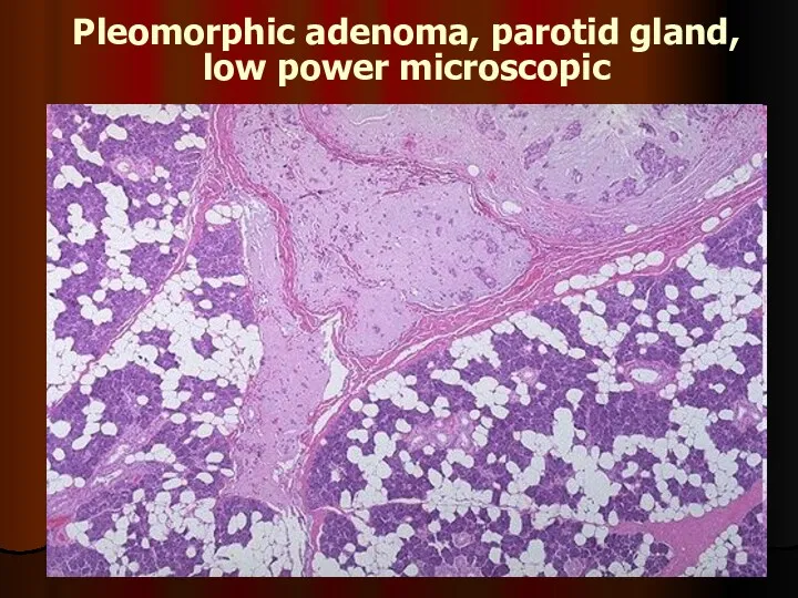 Pleomorphic adenoma, parotid gland, low power microscopic