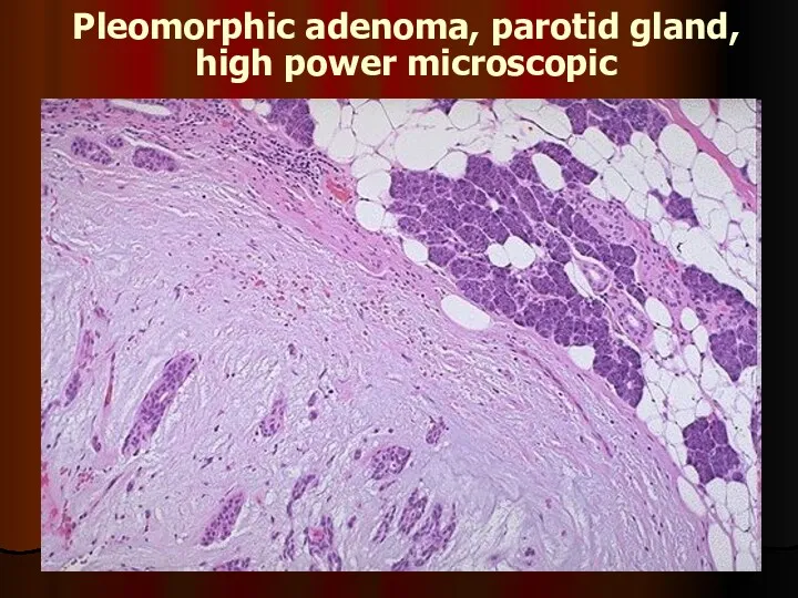Pleomorphic adenoma, parotid gland, high power microscopic