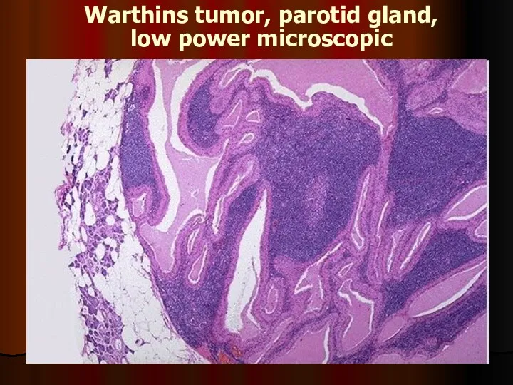 Warthins tumor, parotid gland, low power microscopic