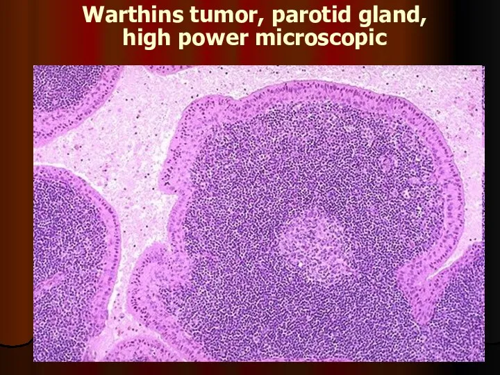 Warthins tumor, parotid gland, high power microscopic