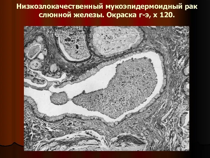 Низкозлокачественный мукоэпидермоидный рак слюнной железы. Окраска г-э, x 120.