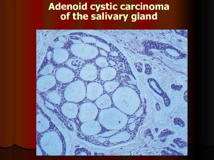 Adenoid cystic carcinoma of the salivary gland