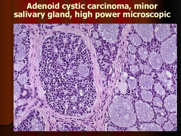 Adenoid cystic carcinoma, minor salivary gland, high power microscopic