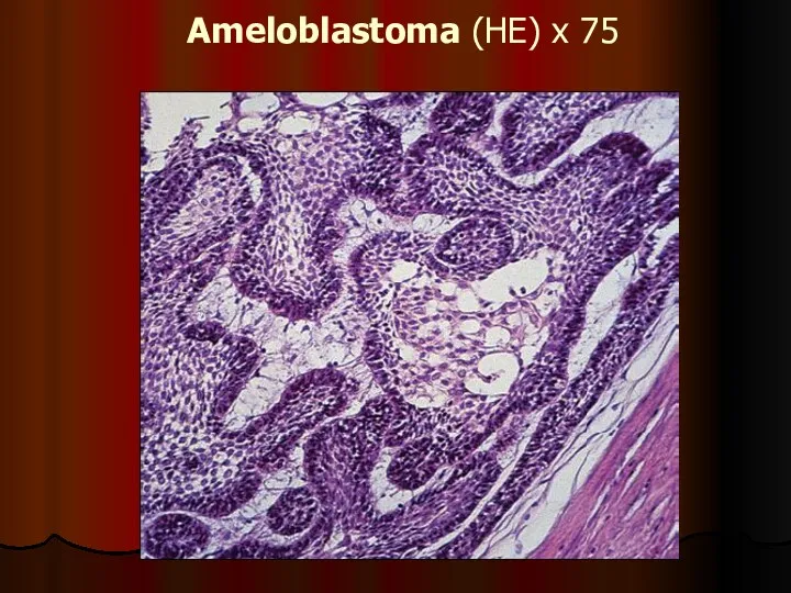Ameloblastoma (HE) x 75