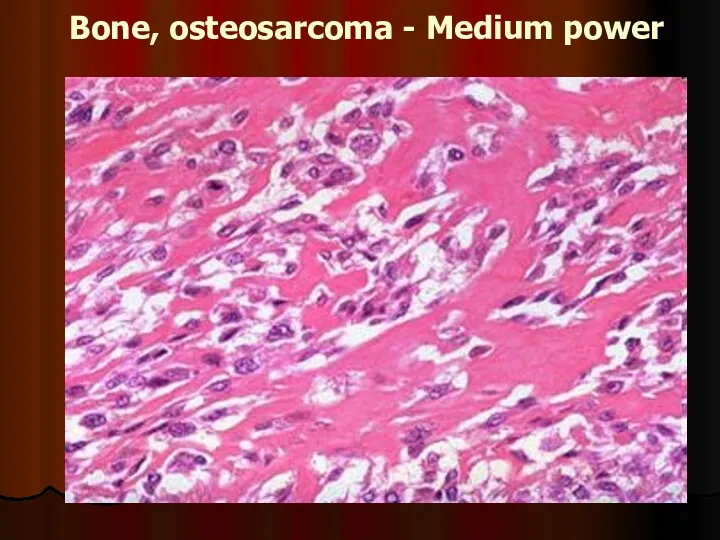 Bone, osteosarcoma - Medium power