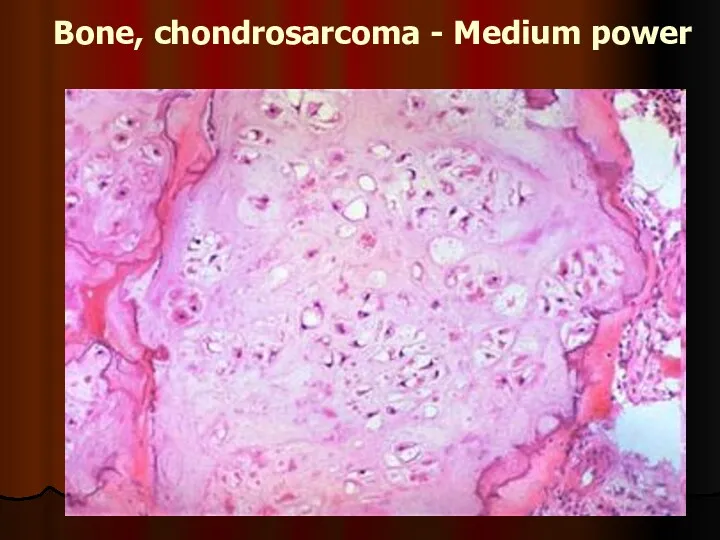 Bone, chondrosarcoma - Medium power