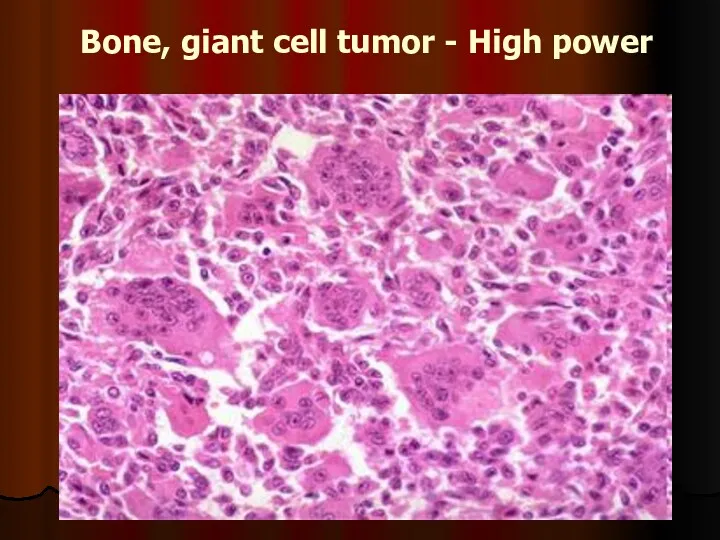 Bone, giant cell tumor - High power
