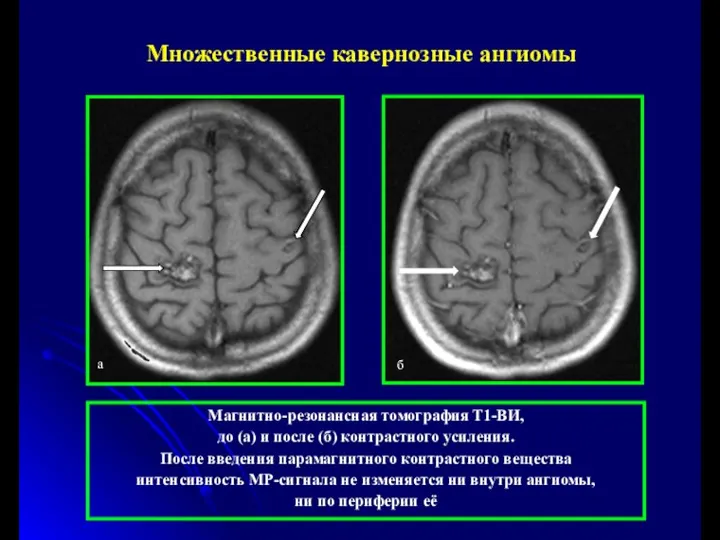 Магнитно-резонансная томография Т1-ВИ, до (а) и после (б) контрастного усиления.