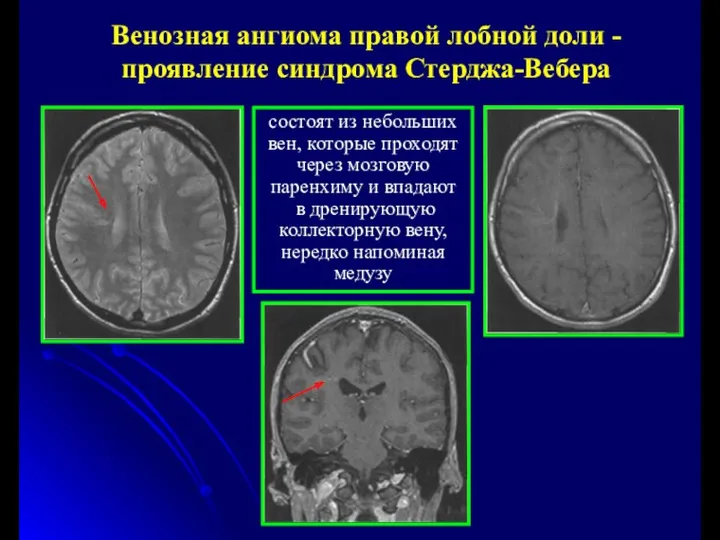 Венозная ангиома правой лобной доли - проявление синдрома Стерджа-Вебера состоят