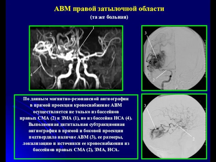 АВМ правой затылочной области (та же больная) По данным магнитно-резонансной