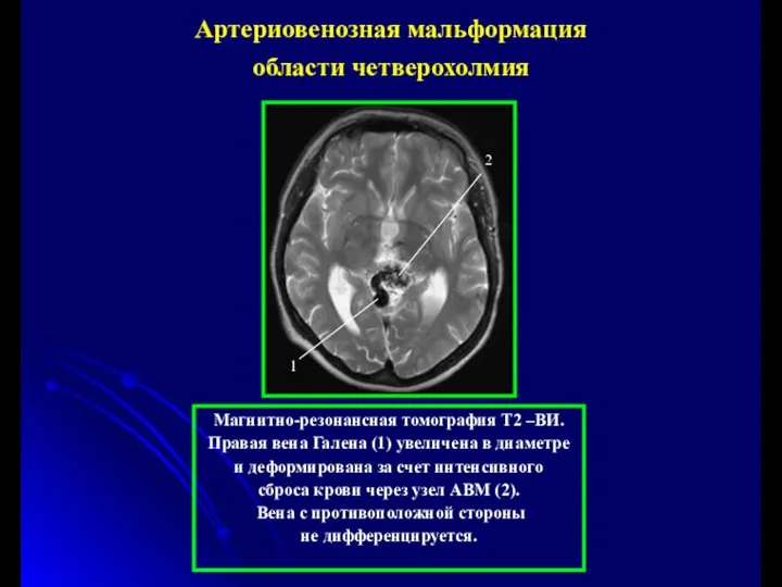 Магнитно-резонансная томография Т2 –ВИ. Правая вена Галена (1) увеличена в