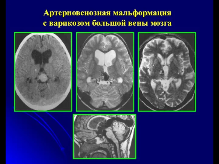 Артериовенозная мальформация с варикозом большой вены мозга