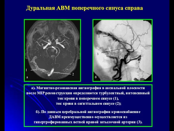 а). Магнитно-резонансная ангиография в аксиальной плоскости после MIP реконструкции определяются