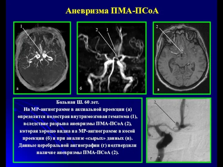 Больная Ш. 60 лет. На МР-ангиограмме в аксиальной проекции (а)