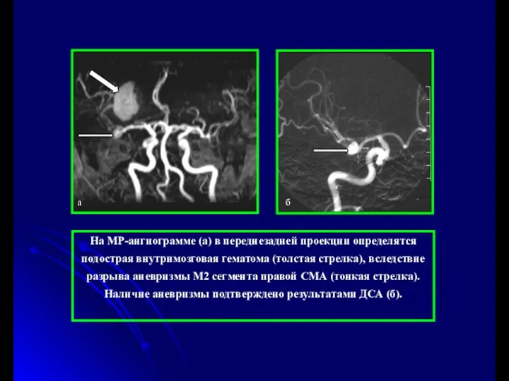 На МР-ангиограмме (а) в переднезадней проекции определятся подострая внутримозговая гематома