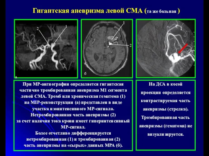 При МР-ангиографии определяется гигантская частично тромбированная аневризма М1 сегмента левой