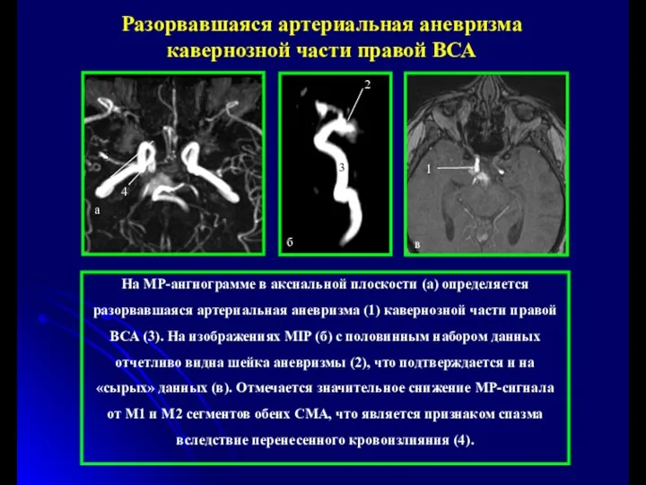 3 На МР-ангиограмме в аксиальной плоскости (а) определяется разорвавшаяся артериальная