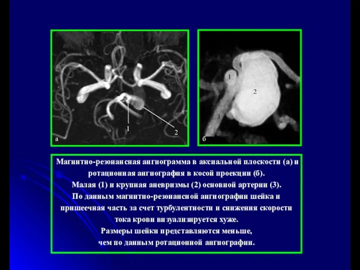 Магнитно-резонансная ангиограмма в аксиальной плоскости (а) и ротационная ангиография в