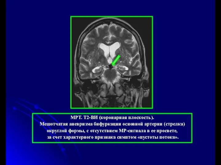 МРТ. Т2-ВИ (коронарная плоскость). Мешотчатая аневризма бифуркации основной артерии (стрелка)