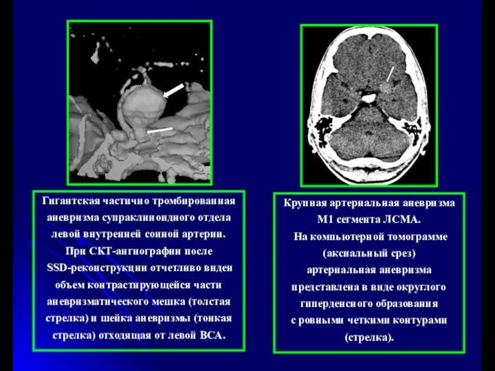 Крупная артериальная аневризма М1 сегмента ЛСМА. На компьютерной томограмме (аксиальный