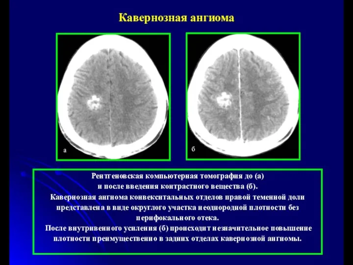 Рентгеновская компьютерная томография до (а) и после введения контрастного вещества