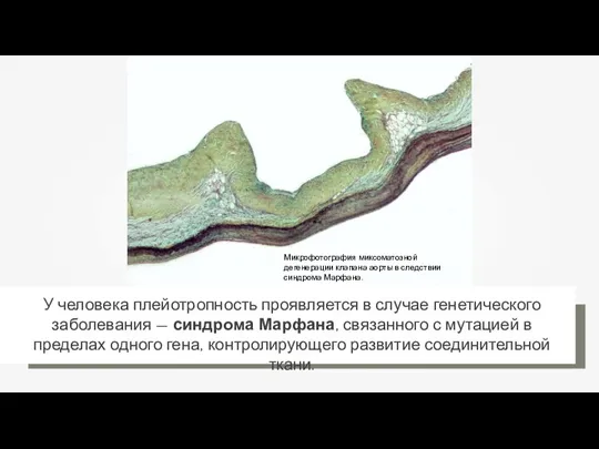 Микрофотография миксоматозной дегенерации клапана аорты в следствии синдрома Марфана.