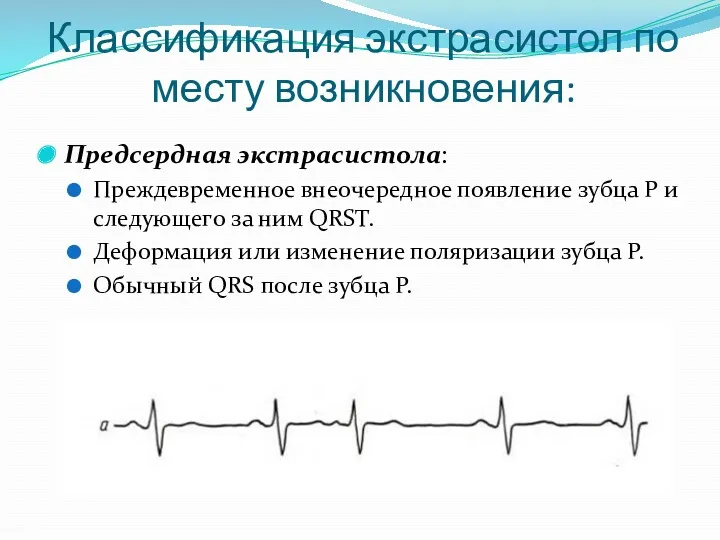 Классификация экстрасистол по месту возникновения: Предсердная экстрасистола: Преждевременное внеочередное появление