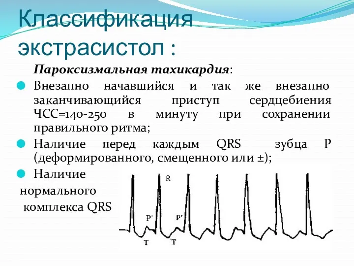 Классификация экстрасистол : Пароксизмальная тахикардия: Внезапно начавшийся и так же