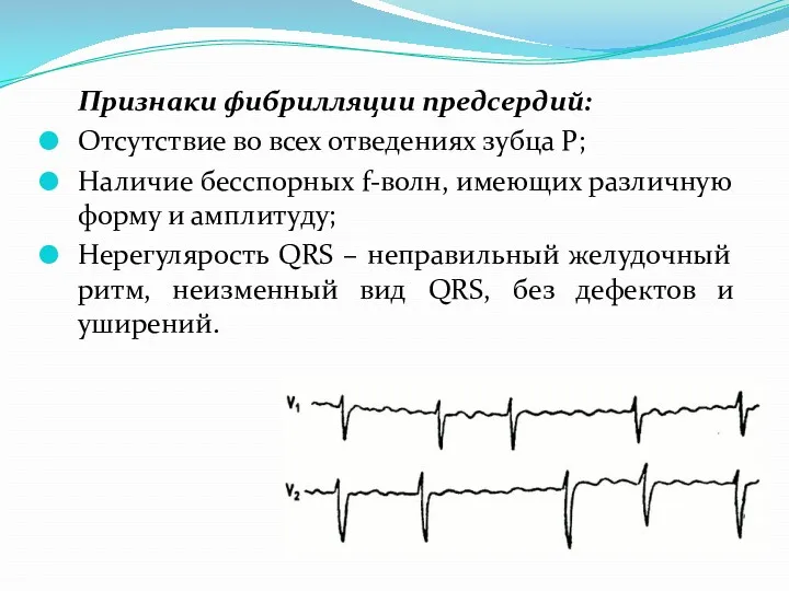 Признаки фибрилляции предсердий: Отсутствие во всех отведениях зубца Р; Наличие