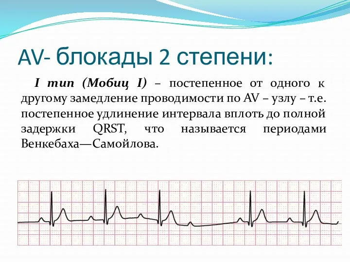 AV- блокады 2 степени: I тип (Мобиц I) – постепенное