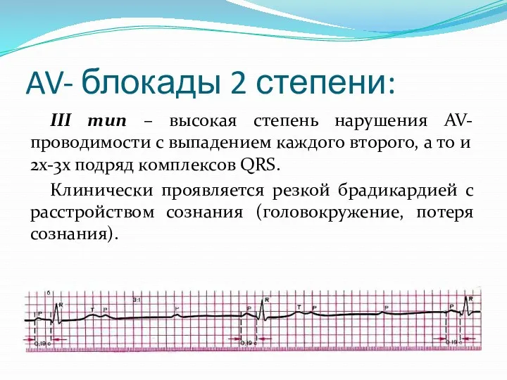 AV- блокады 2 степени: III тип – высокая степень нарушения