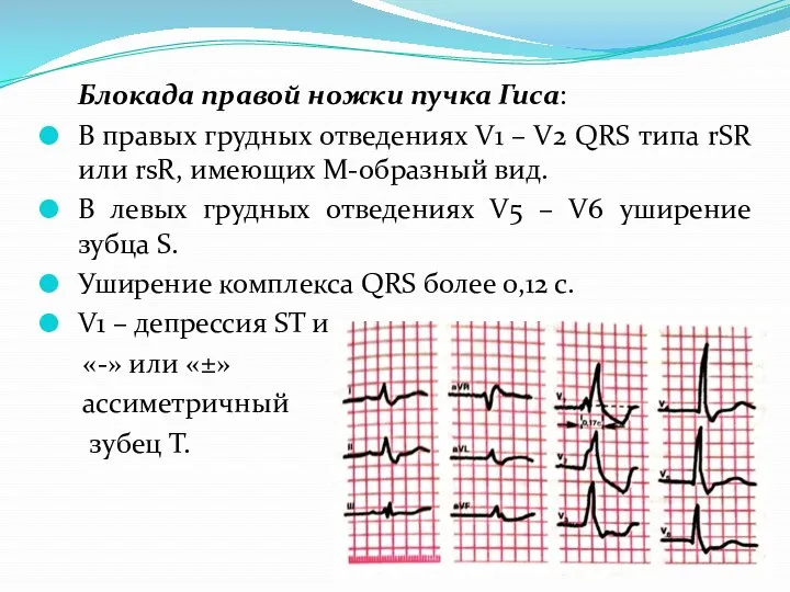 Блокада правой ножки пучка Гиса: В правых грудных отведениях V1