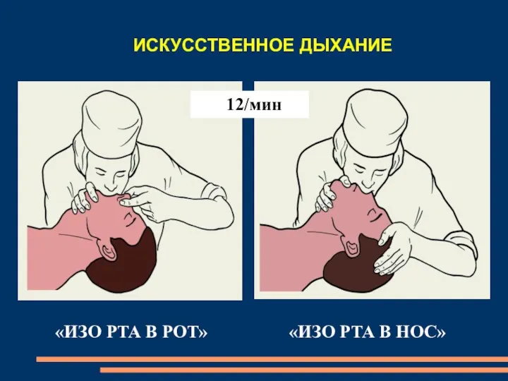 ИСКУССТВЕННОЕ ДЫХАНИЕ «ИЗО РТА В РОТ» «ИЗО РТА В НОС» 12/мин