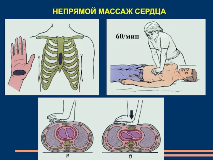 НЕПРЯМОЙ МАССАЖ СЕРДЦА 60/мин