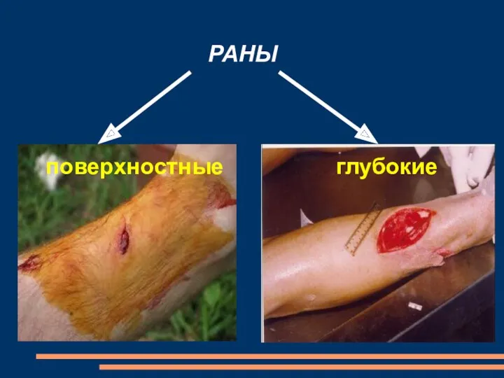 РАНЫ поверхностные глубокие