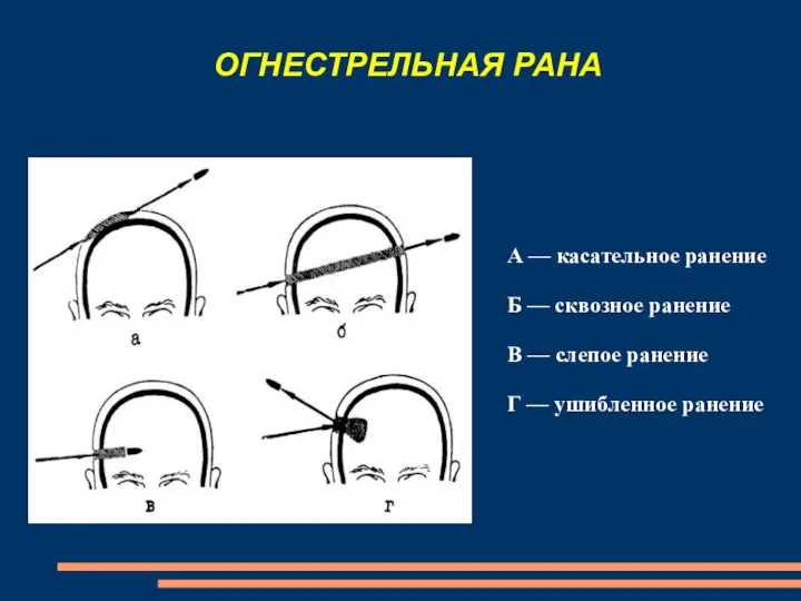 ОГНЕСТРЕЛЬНАЯ РАНА А — касательное ранение Б — сквозное ранение