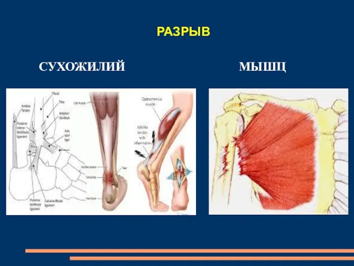 РАЗРЫВ СУХОЖИЛИЙ МЫШЦ