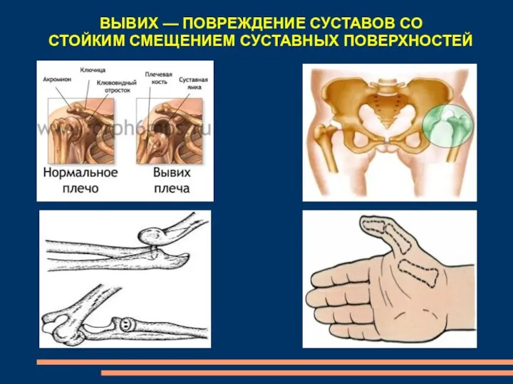 ВЫВИХ — ПОВРЕЖДЕНИЕ СУСТАВОВ СО СТОЙКИМ СМЕЩЕНИЕМ СУСТАВНЫХ ПОВЕРХНОСТЕЙ