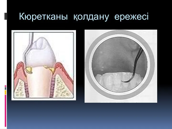 Кюретканы қолдану ережесі