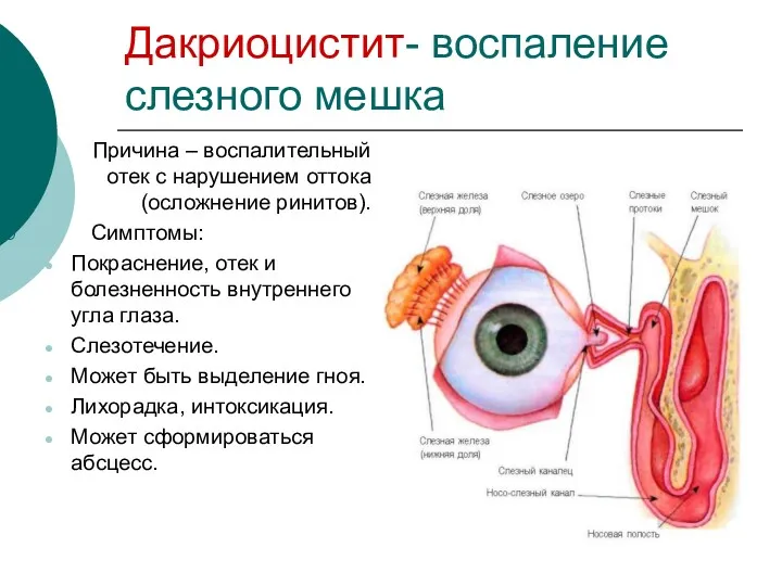 Дакриоцистит- воспаление слезного мешка Причина – воспалительный отек с нарушением