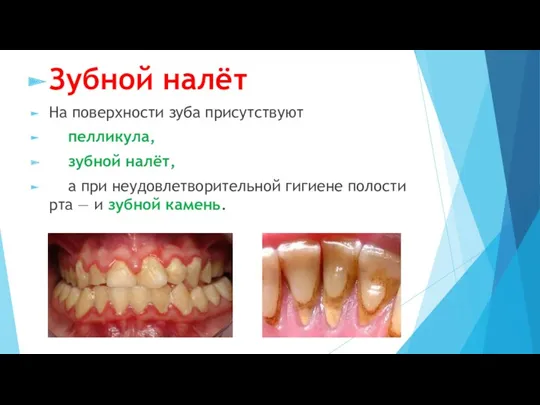 Зубной налёт На поверхности зуба присутствуют пелликула, зубной налёт, а
