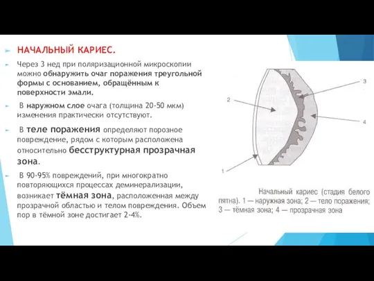 НАЧАЛЬНЫЙ КАРИЕС. Через 3 нед при поляризационной микроскопии можно обнаружить