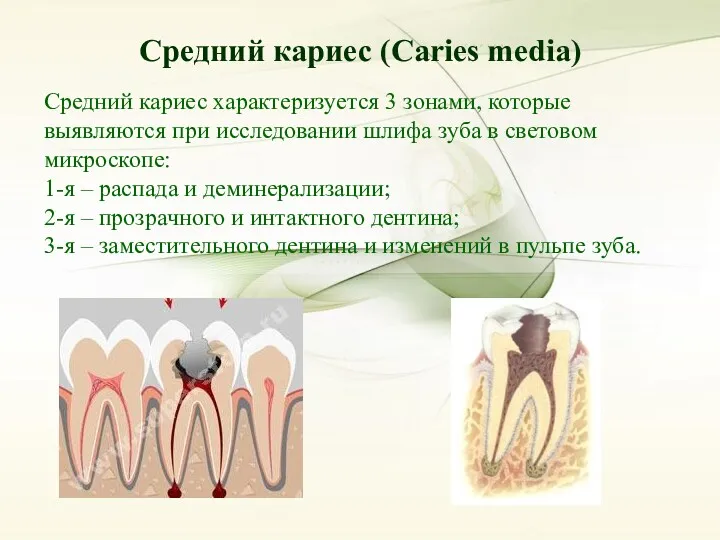 Средний кариес (Caries media) Средний кариес (Caries media) Средний кариес