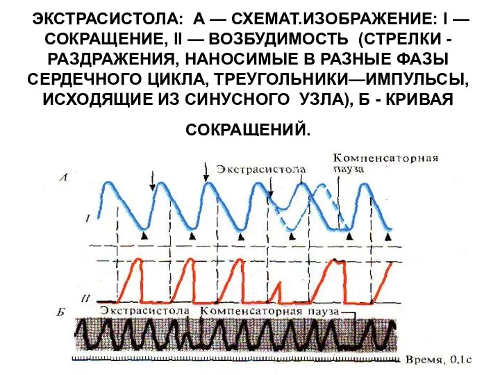 ЭКСТРАСИСТОЛА: А — СХЕМАТ.ИЗОБРАЖЕНИЕ: I — СОКРАЩЕНИЕ, II — ВОЗБУДИМОСТЬ