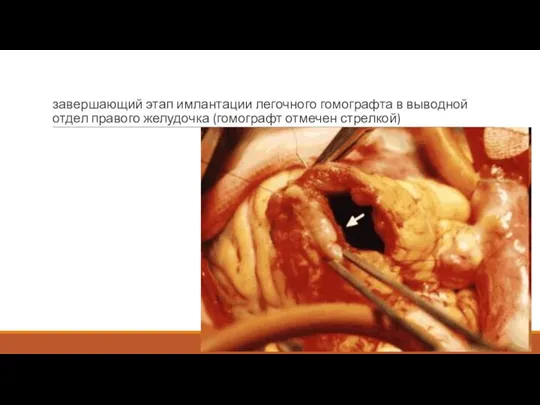 завершающий этап имлантации легочного гомографта в выводной отдел правого желудочка (гомографт отмечен стрелкой)