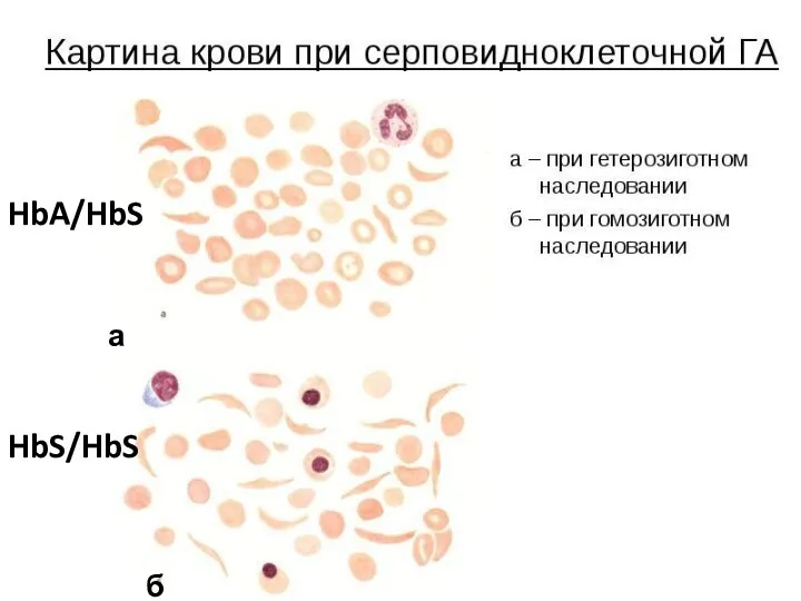 а б HbA/HbS HbS/HbS